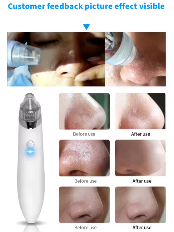 Extractor Facial Eléctrico – Cuida tu piel desde casa